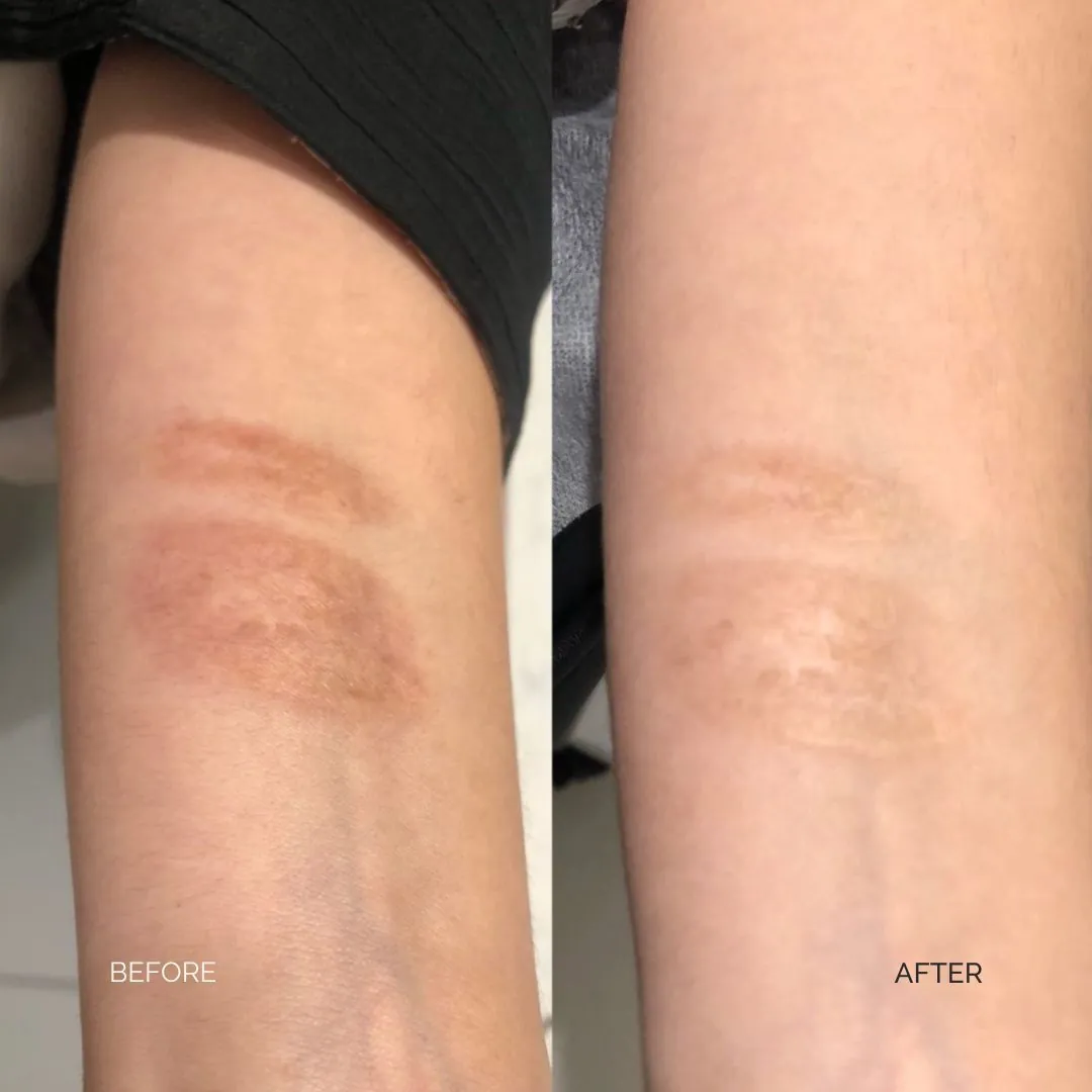 Burn scars before and after Inkless Scar Revision and red light therapy