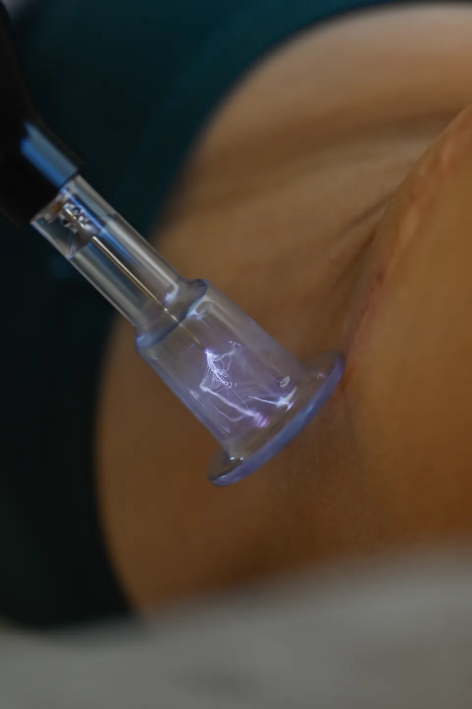 Fusion 8 plasma handpiece treating the skin