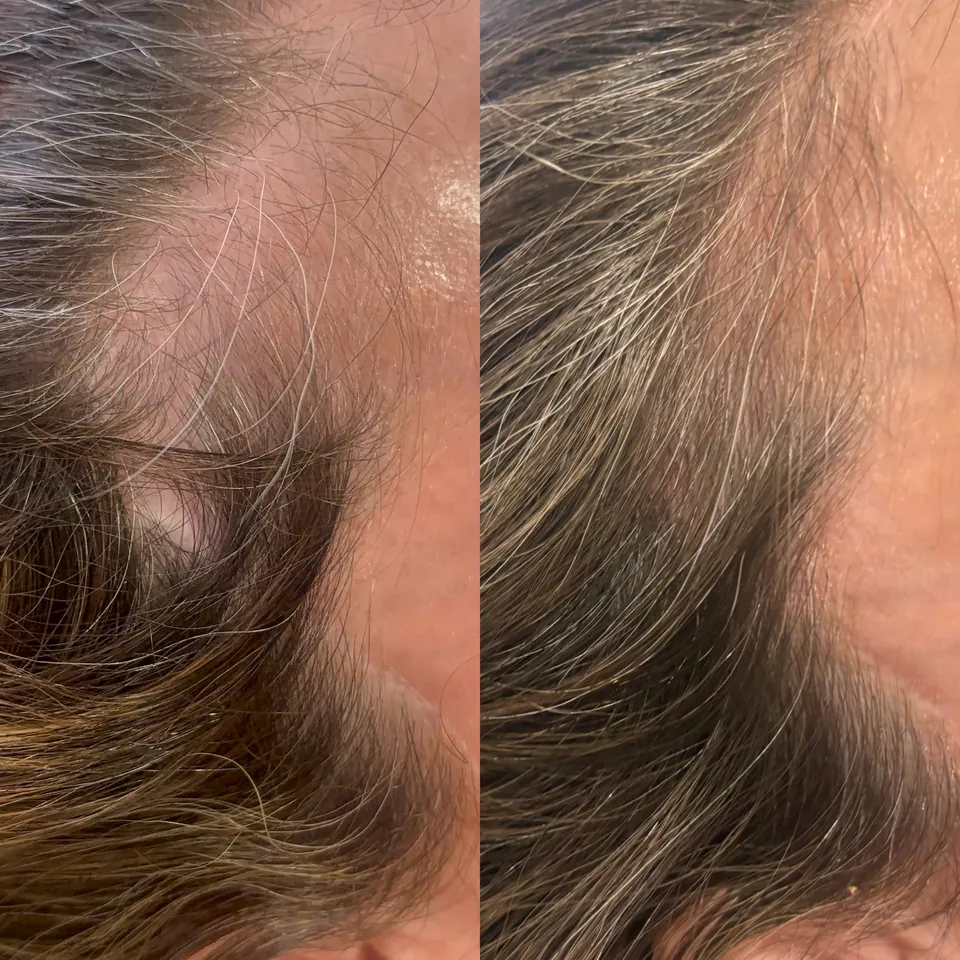 Hair loss recovery two years after facelift surgery, six sessions of the hair protocol