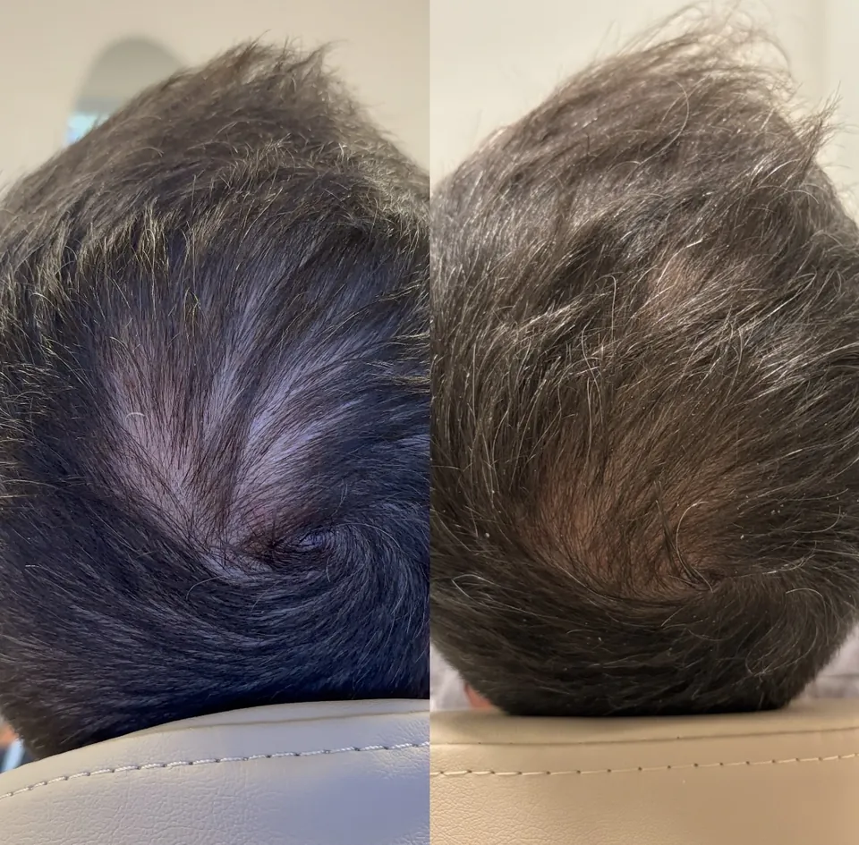 Six sessions of the hair protocol with consistent red and infrared light