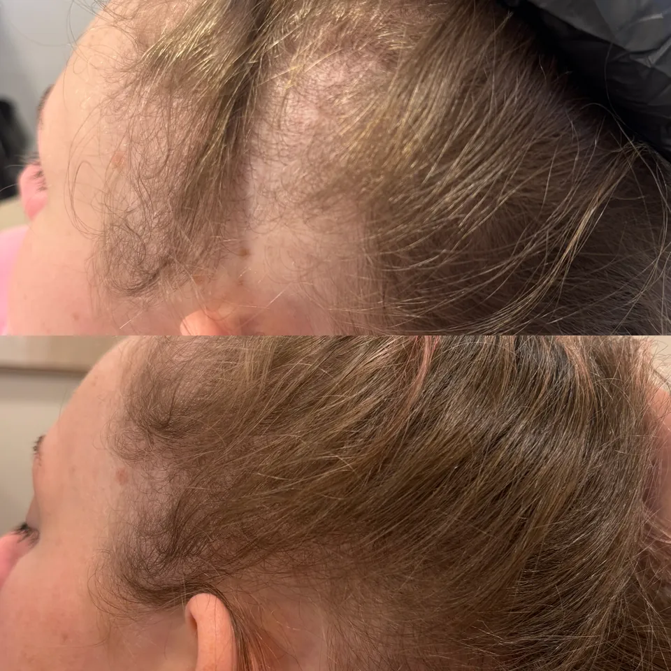 Six weekly sessions of the hair protocol with daily red light at home