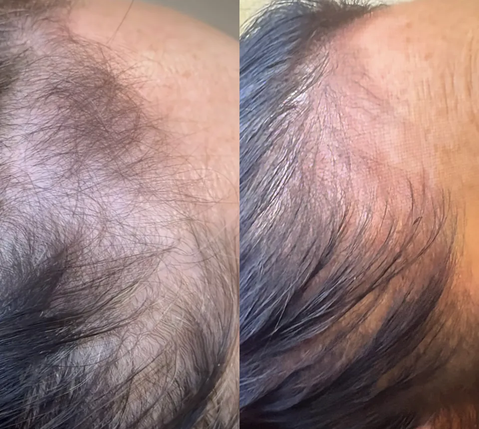 Hairline before and after the hair protocol
