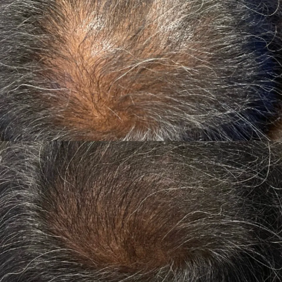 Crown before and after the hair protocol