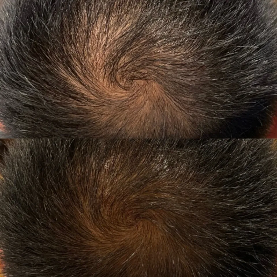 Crown before and after the hair protocol