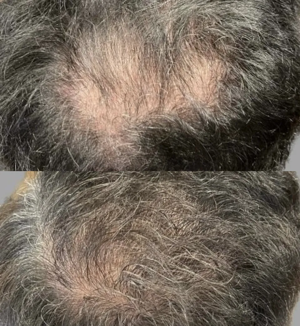 Crown before and after the hair protocol