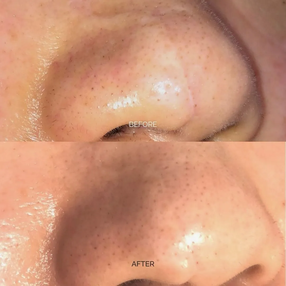 Childhood accident scar before and after Inkless Scar Revision