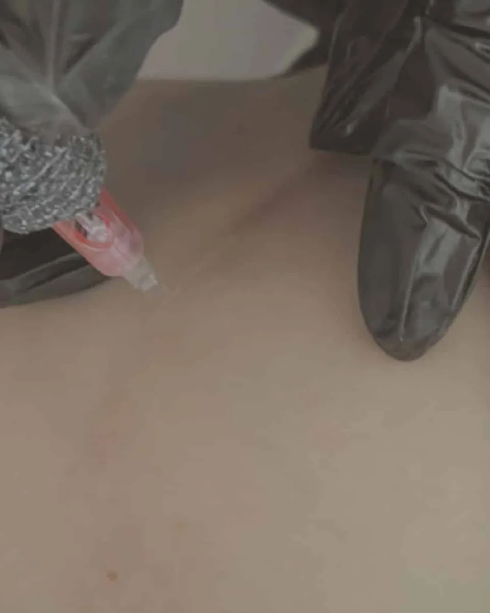 A close-up of gloved hands injecting a needle into the skin near a faint scar.