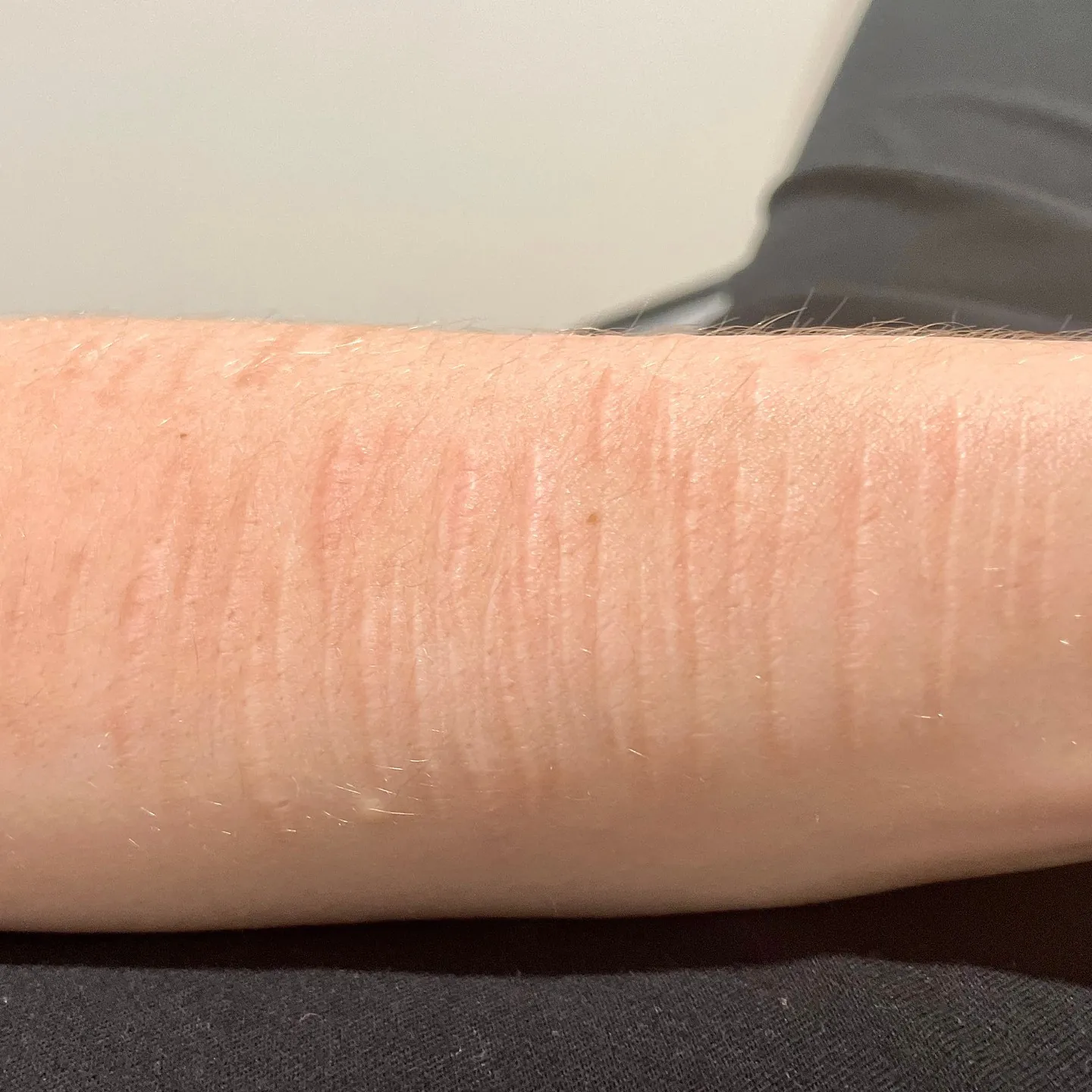 Self harm scars during Inkless Revision treatment at Love Skin With Aydan