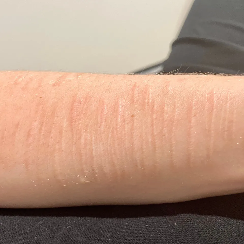 Self harm scars during Inkless Revision treatment at Love Skin With Aydan