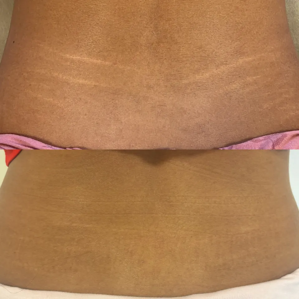 Close-up of two knees side by side, both showing areas of healed, light-colored scars on the skin.