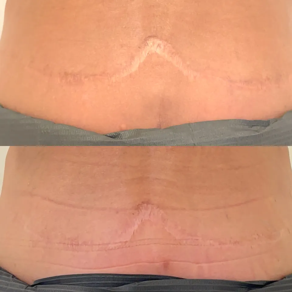 Surgical scar progress after two sessions of colour correction and texture work