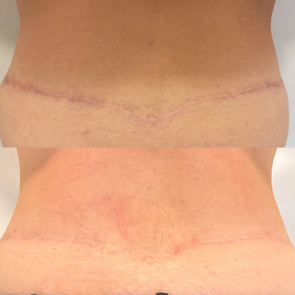 Surgical scar before and after two Inkless, red light and four Camouflage sessions