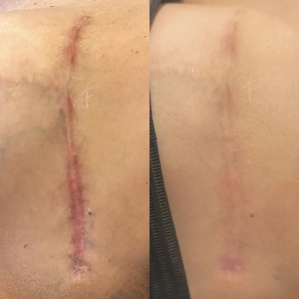 Breast augmentation scar progress after 10 red light and scar tissue massage sessions and one plasma treatment