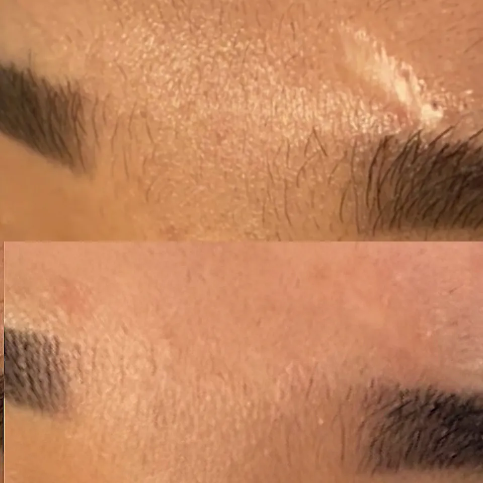Scar by the eyebrow after one combined Fusion 8 and Inkless session, with colour and texture improvement