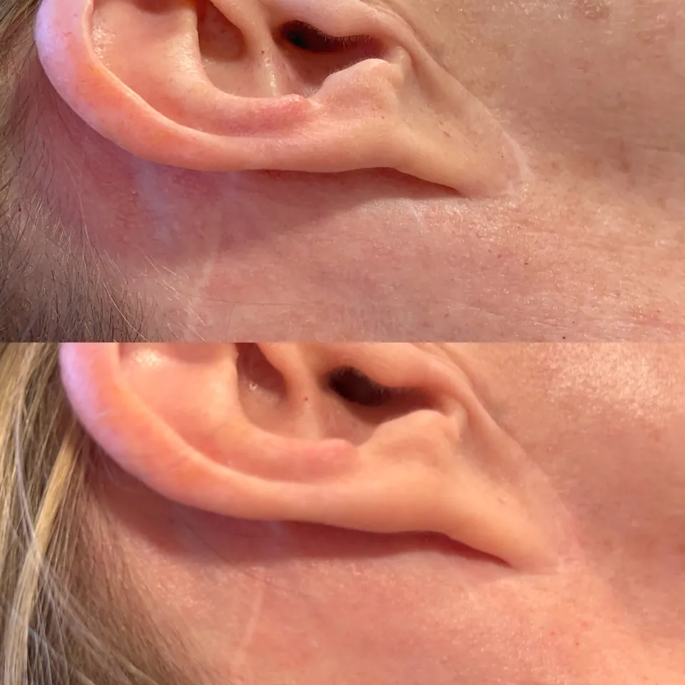 Facelift scar before and after one Inkless treatment