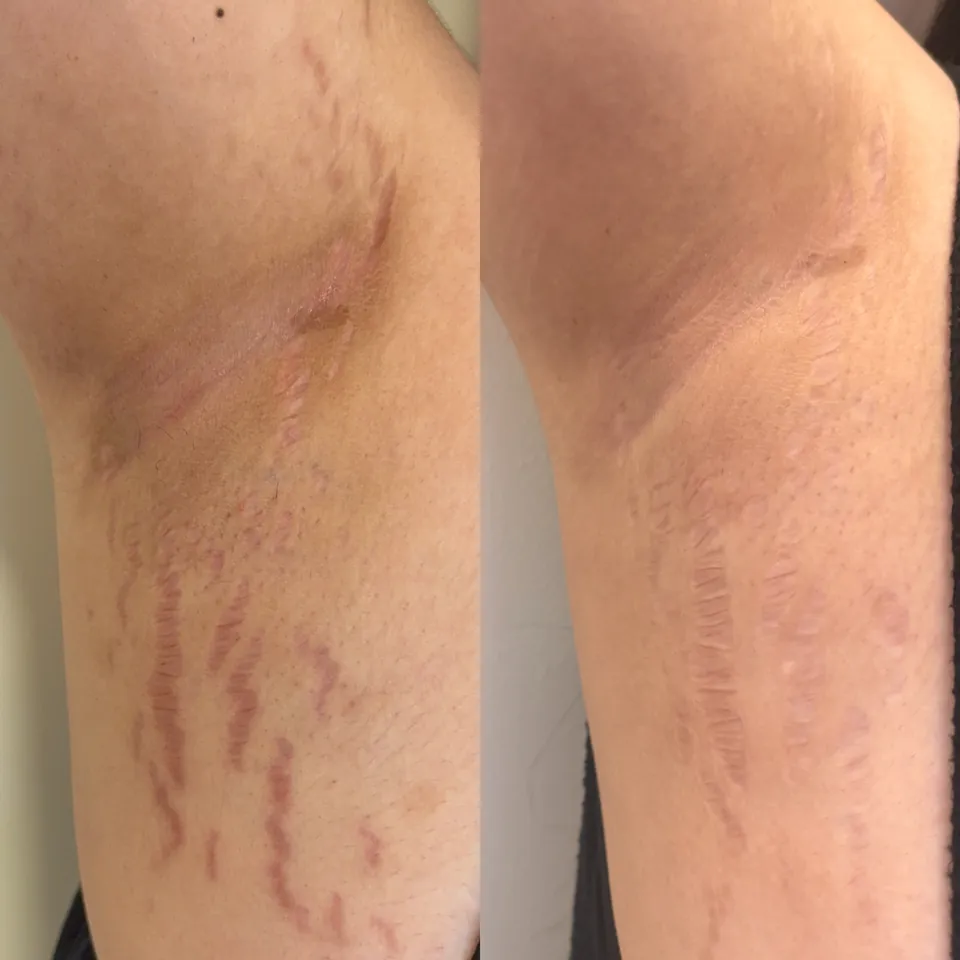 Stretch marks after a regular treatment plan alternating Fusion 8 Plasma and Inkless