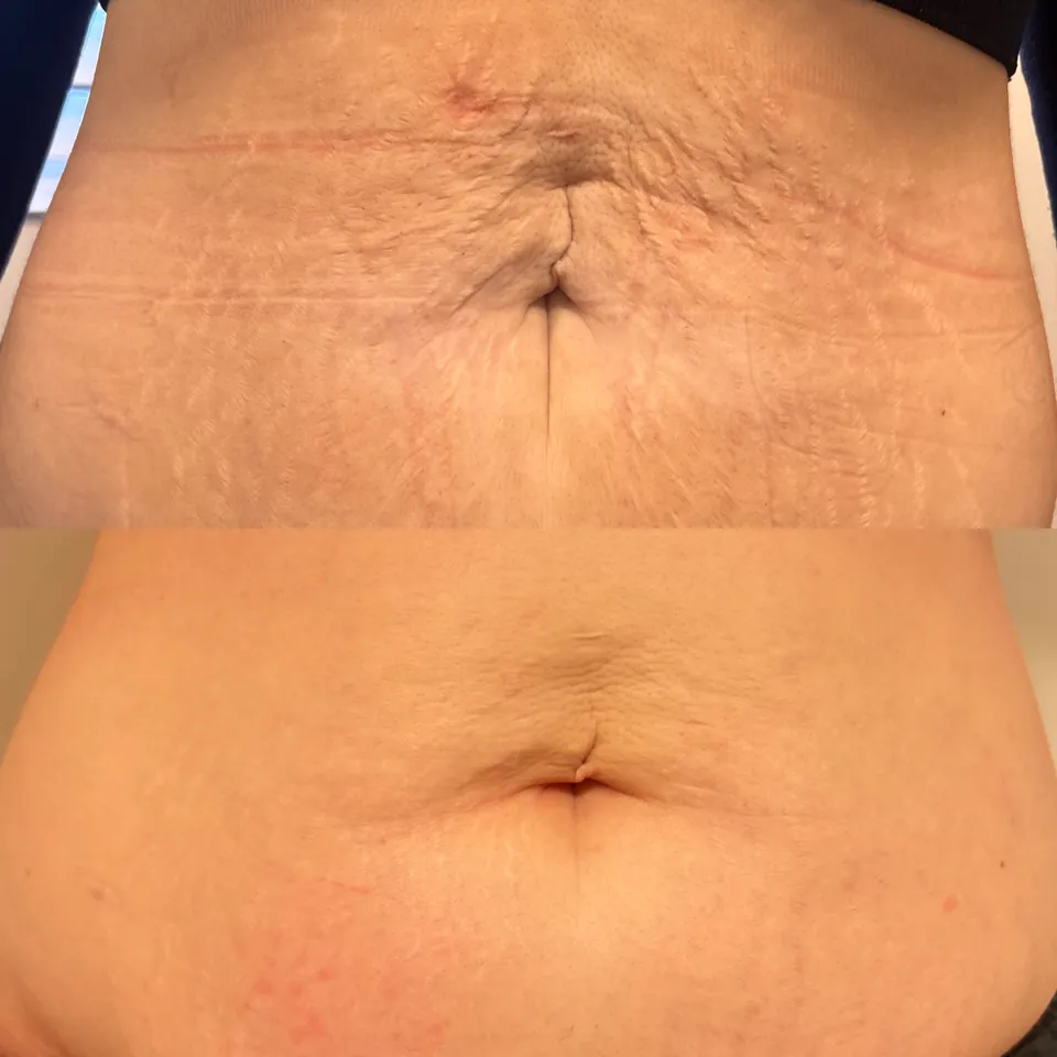 Mummy tummy before and after one plasma and one Inkless treatment