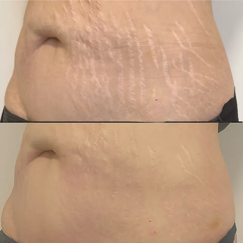 Stomach stretch marks after Inkless, plasma and Inkless treatments