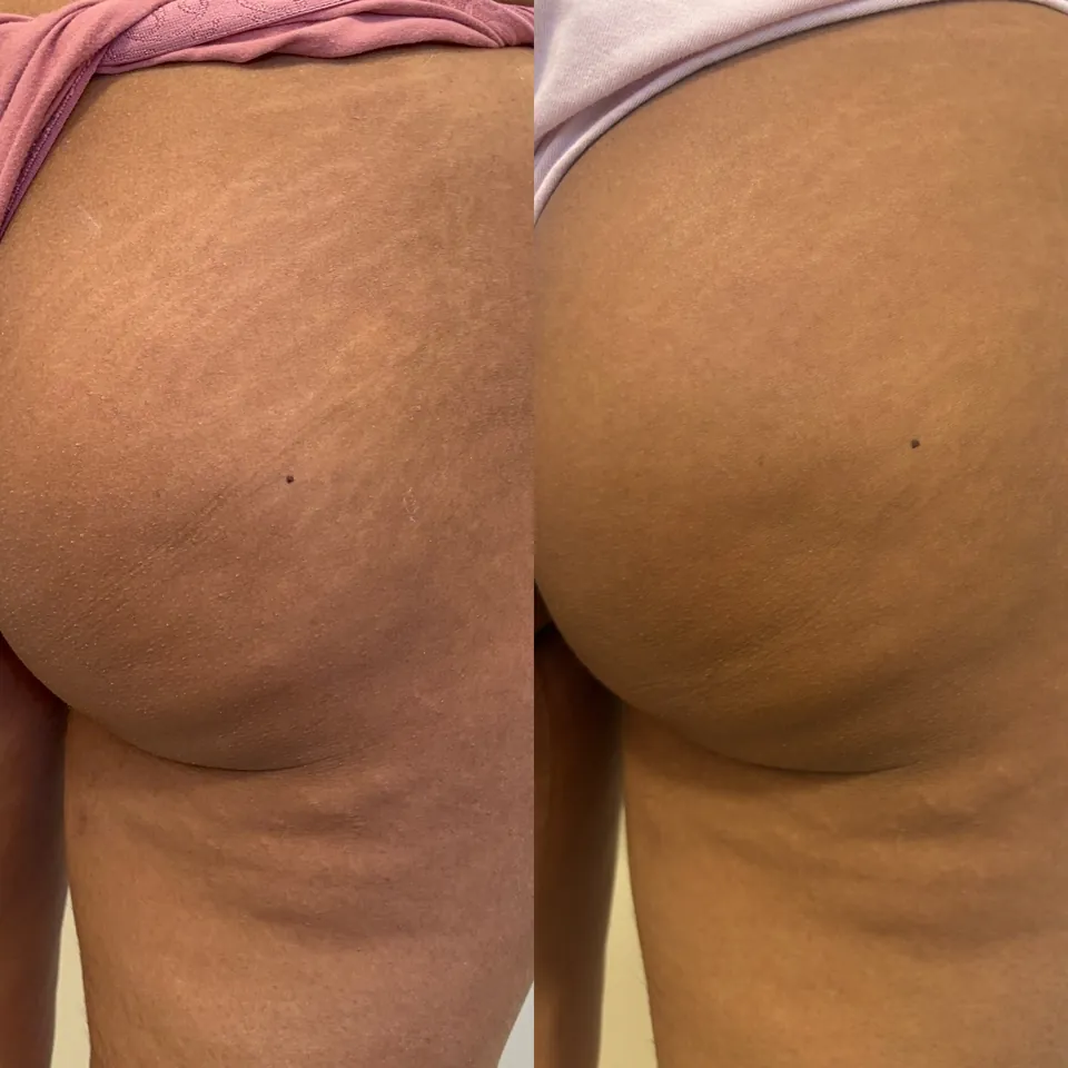 A person’s upper arm and armpit area shown in two images; the top shows visible stretch marks, while the bottom shows reduced appearance of stretch marks.