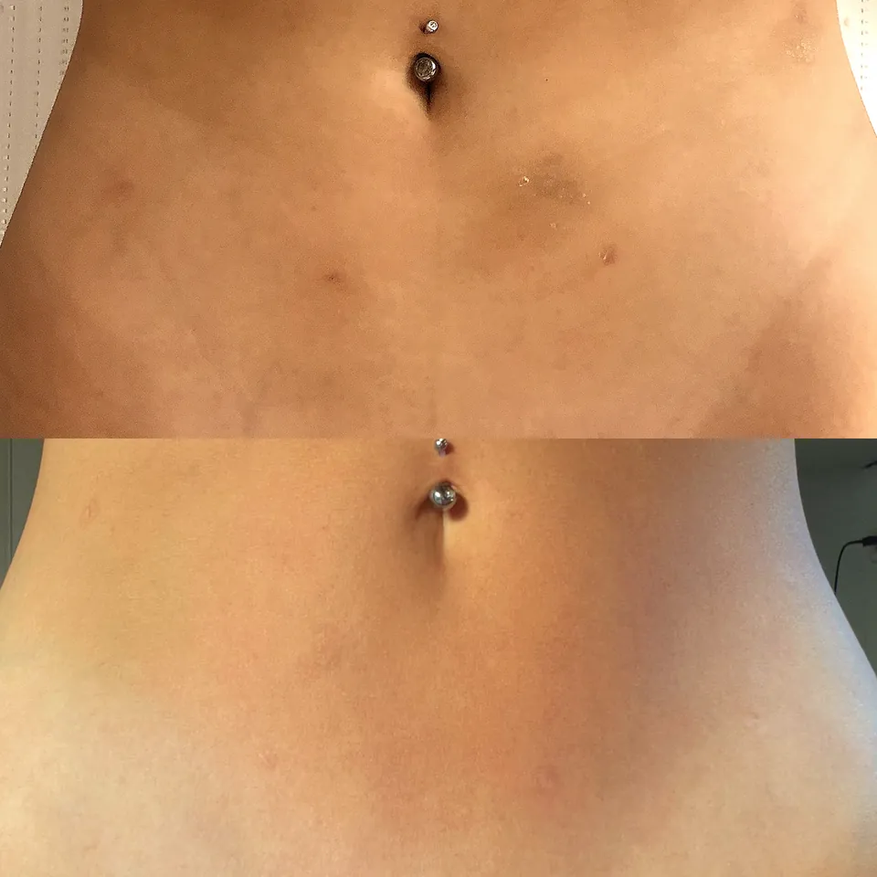 Body tite procedure scars after four LED sessions and one Camouflage session