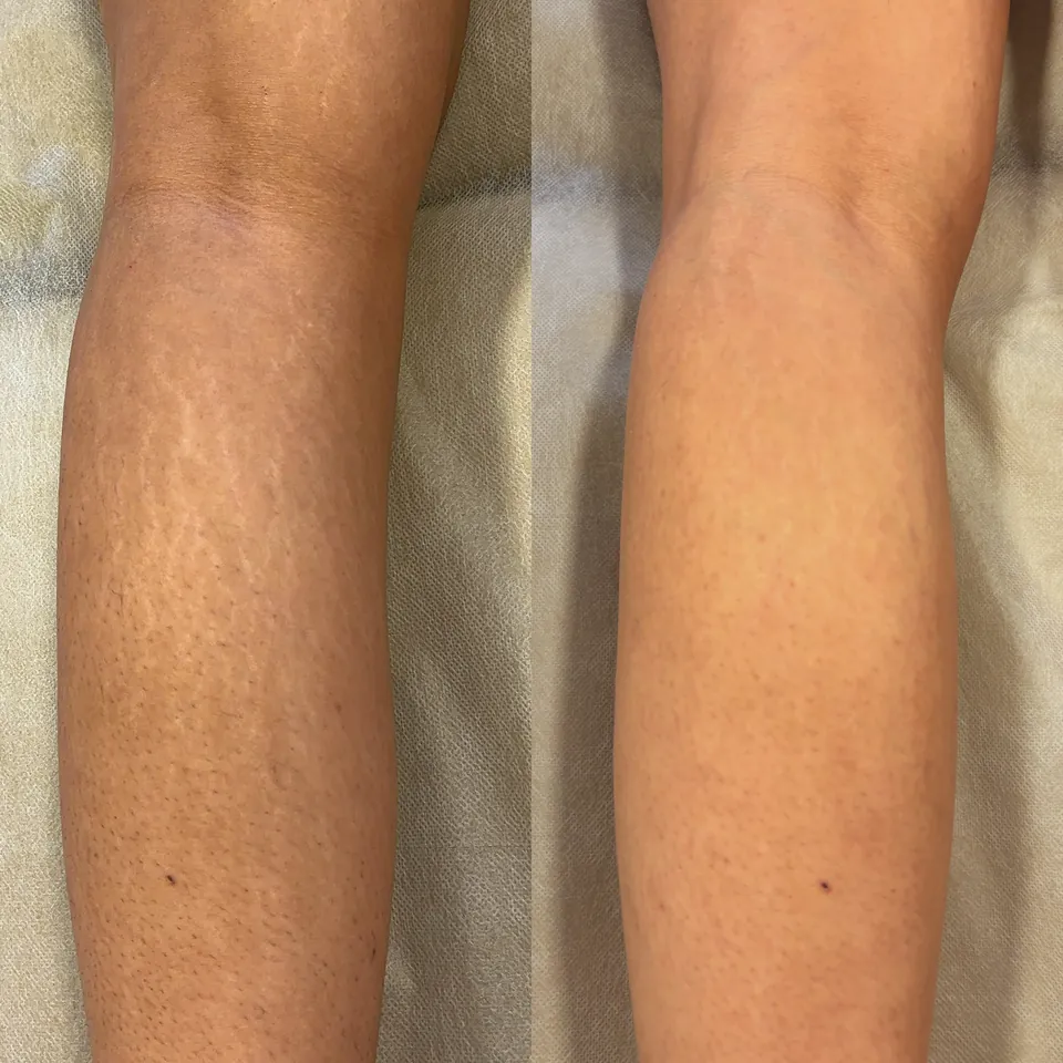 Side-by-side comparison of knees, showing reduced visibility of scars or discoloration on the right side compared to the left.