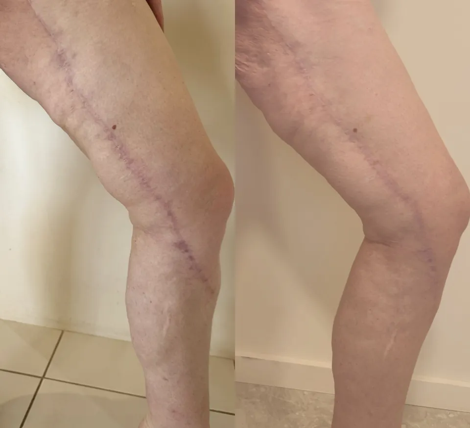 Leg scar progress with consistent red light therapy and four plasma sessions