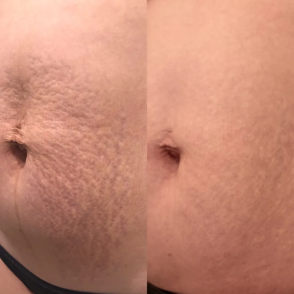 Stomach stretch marks before and after two Inkless and two plasma treatments