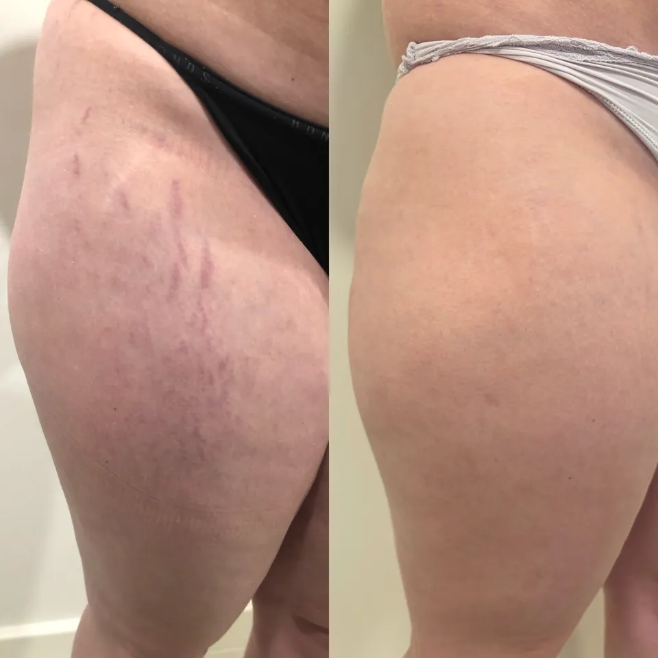 Side-by-side comparison of an upper arm before and after treatment, showing reduced appearance of stretch marks and smoother skin in the after image.