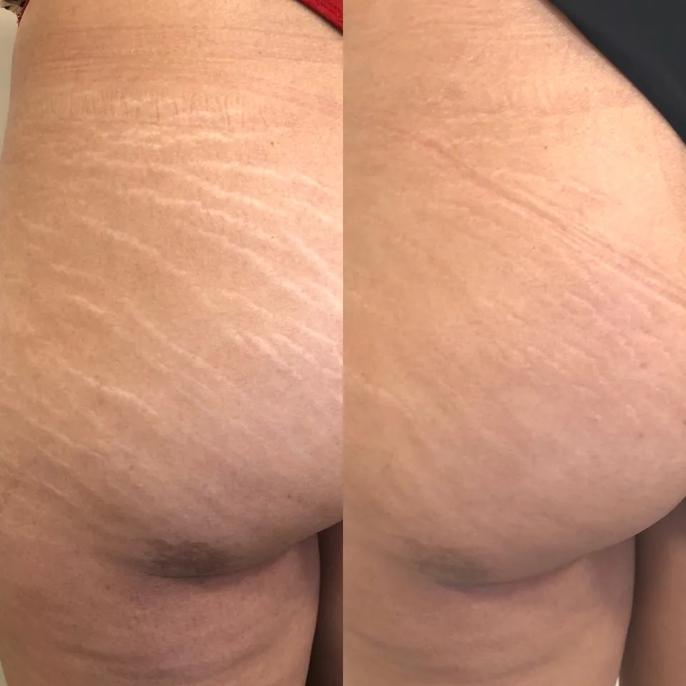 Two photos show a person's knee area; the top image has several white patches on the skin, while the bottom image shows the patches have faded or are less visible.
