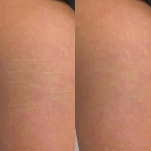 Side-by-side close-up of skin, showing stretch marks on the left and smoother skin with reduced marks on the right.