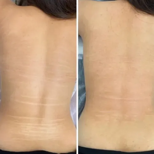 Side-by-side comparison of a person's back showing stretch marks on the left and visibly reduced stretch marks on the right.