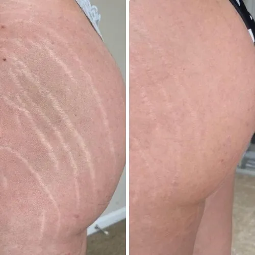 Side-by-side comparison of a person's hip and buttock showing visible stretch marks on the left and reduced appearance of stretch marks on the right.