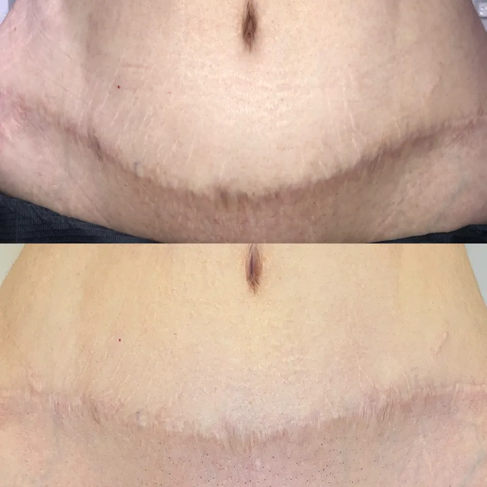 Surgical scar and stretch marks after consistent LED therapy, scar massage and one Inkless session