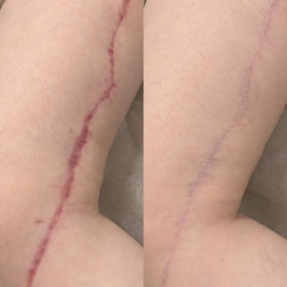 Thigh lift scar after the Fresh Scar Protocol, consistent LED, scar massage and two scar treatments