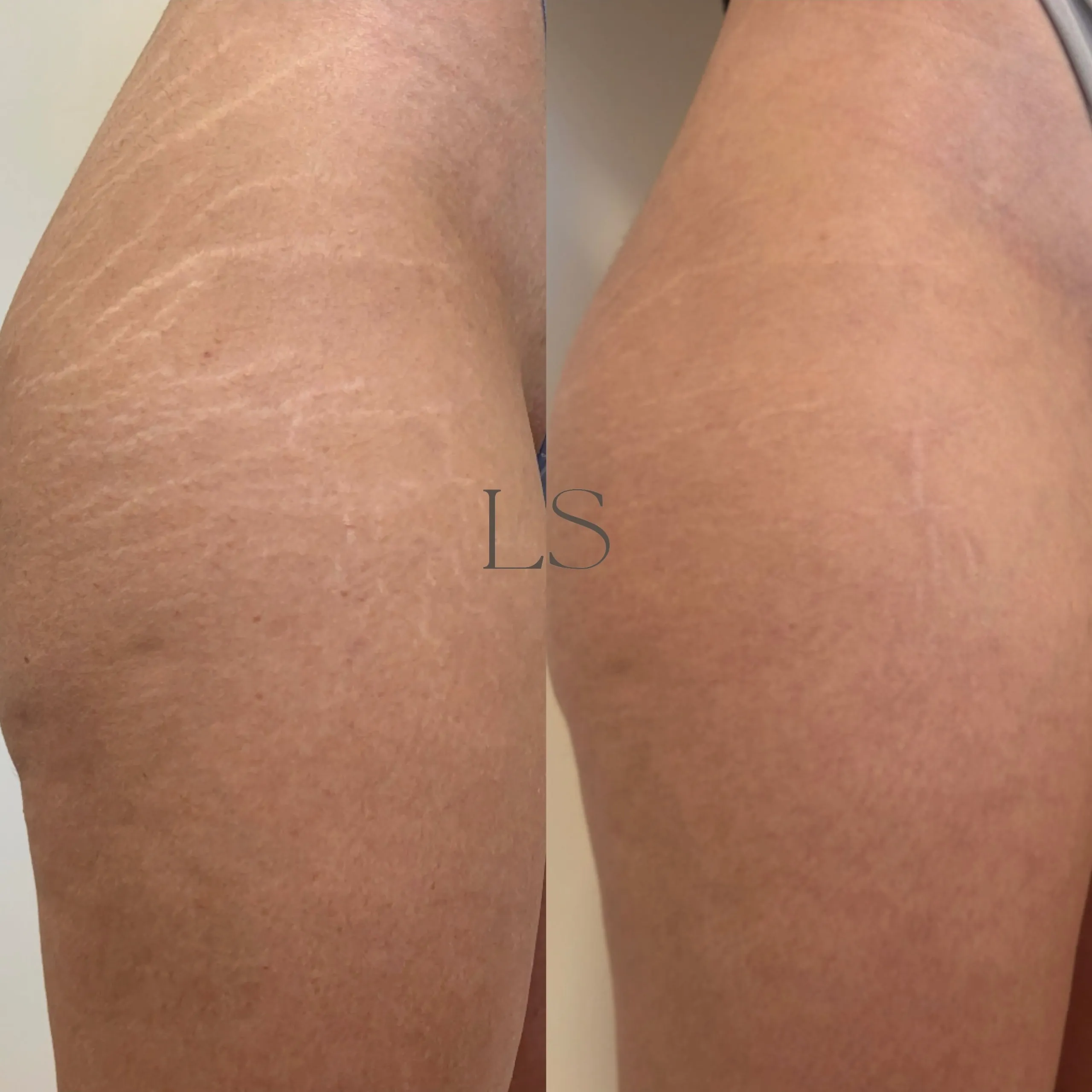 Stretch marks before and after Inkless Revision
