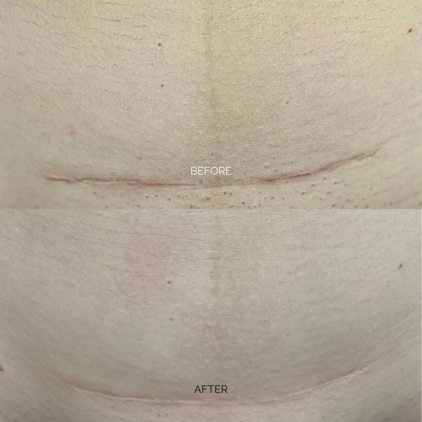 C-section scar before and after two Inkless Scar Revision treatments