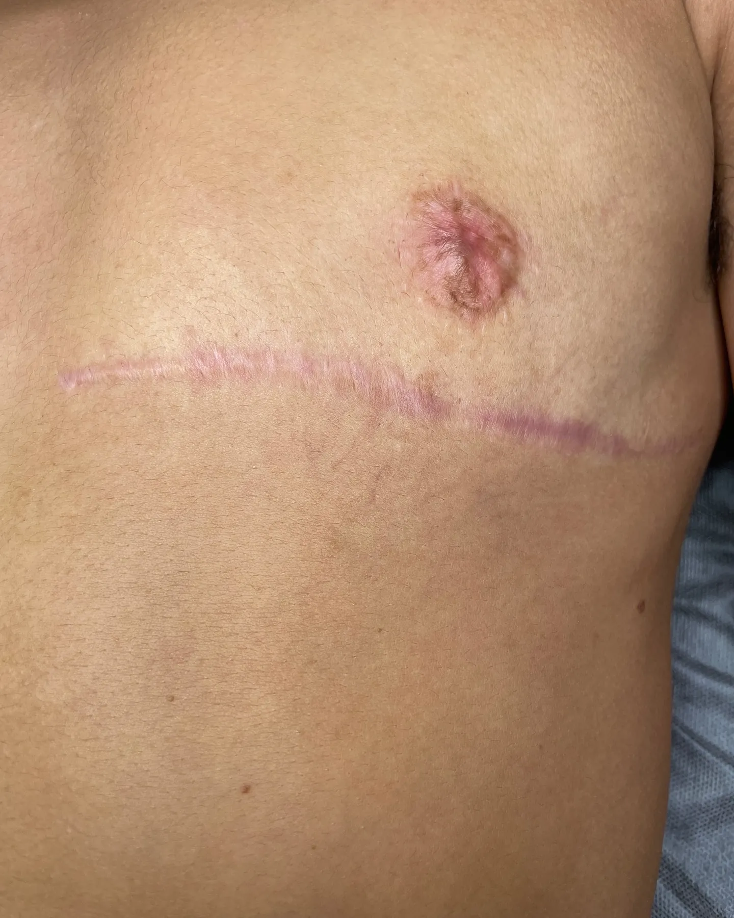 Transition scars on the chest being treated at Love Skin With Aydan