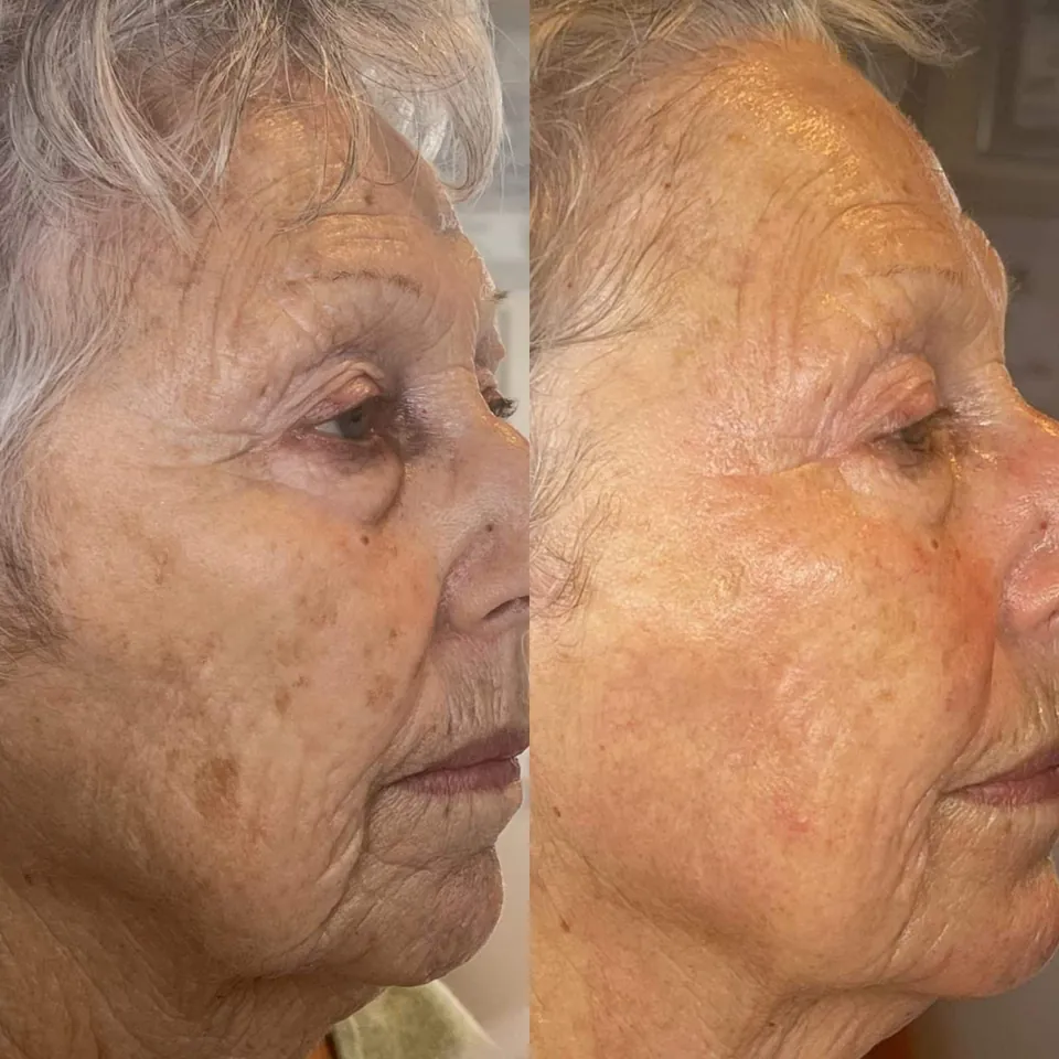 Warm Plasma before and after