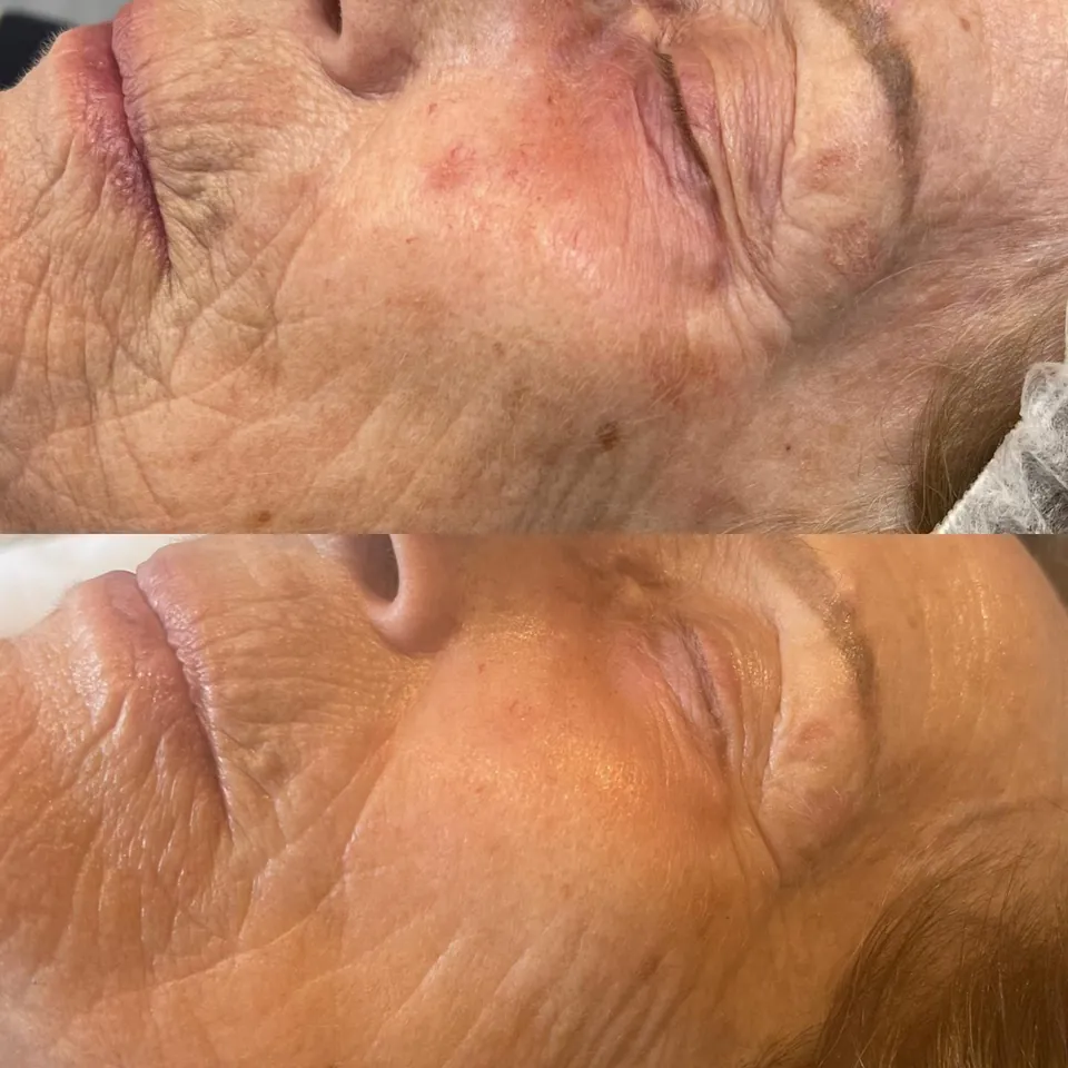 Warm Plasma before and after