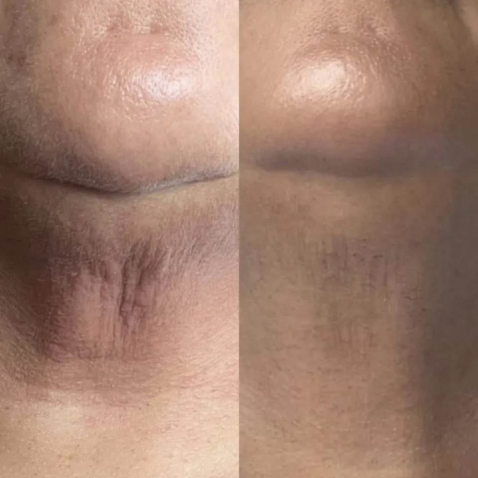 Warm Plasma before and after