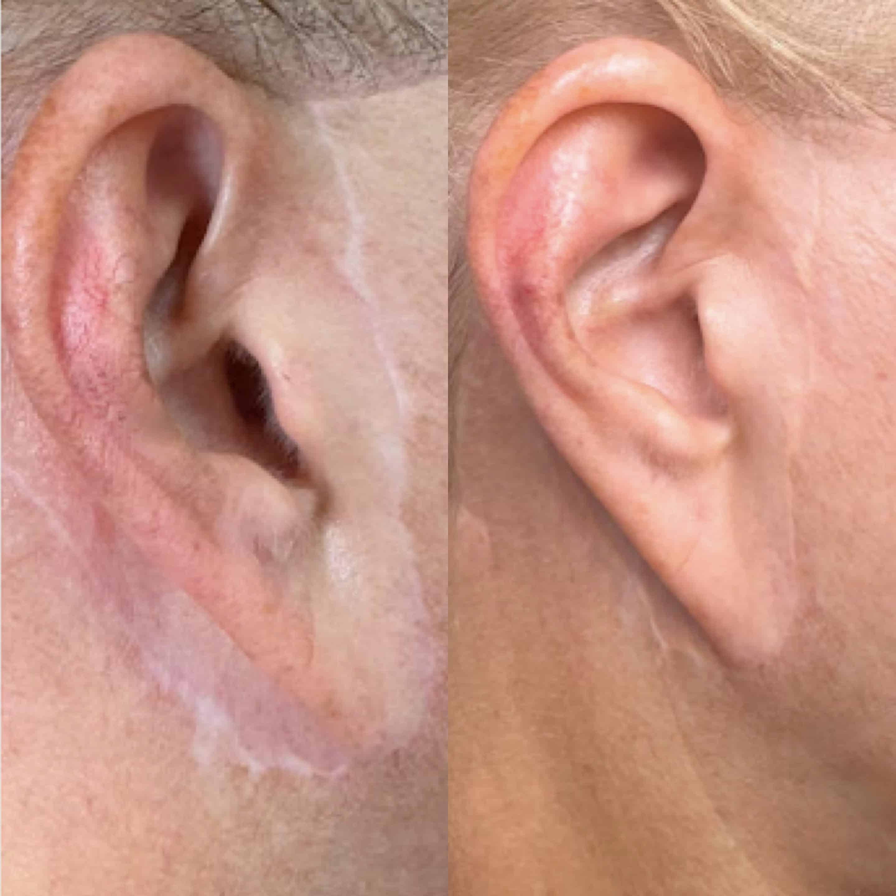 Before and after scar treatment