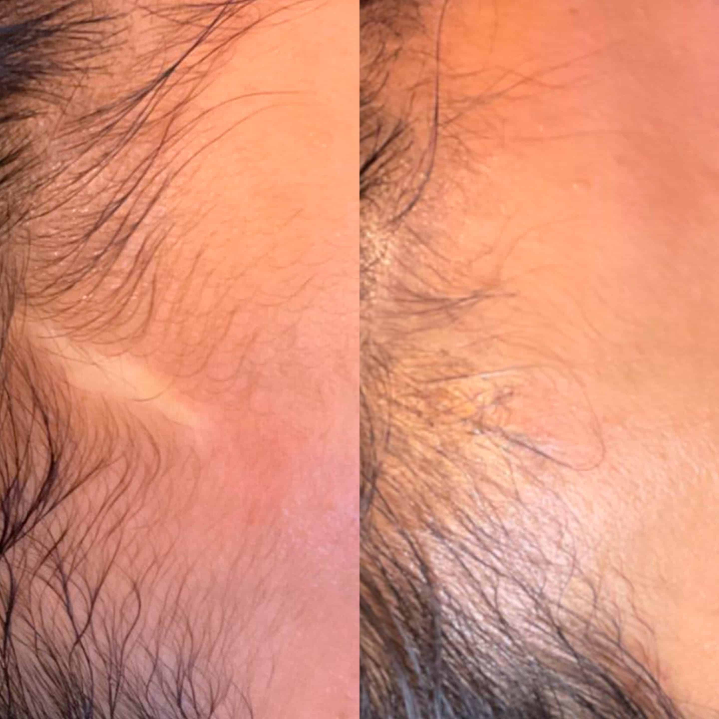 Before and after scar treatment