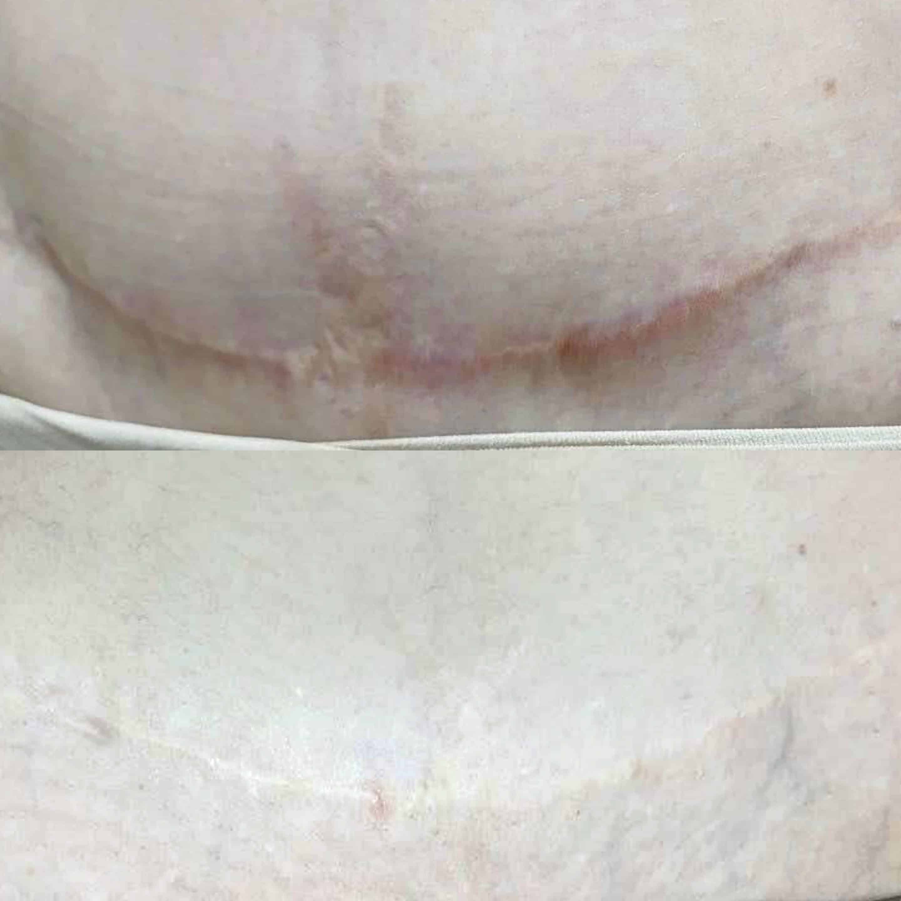 Before and after scar treatment