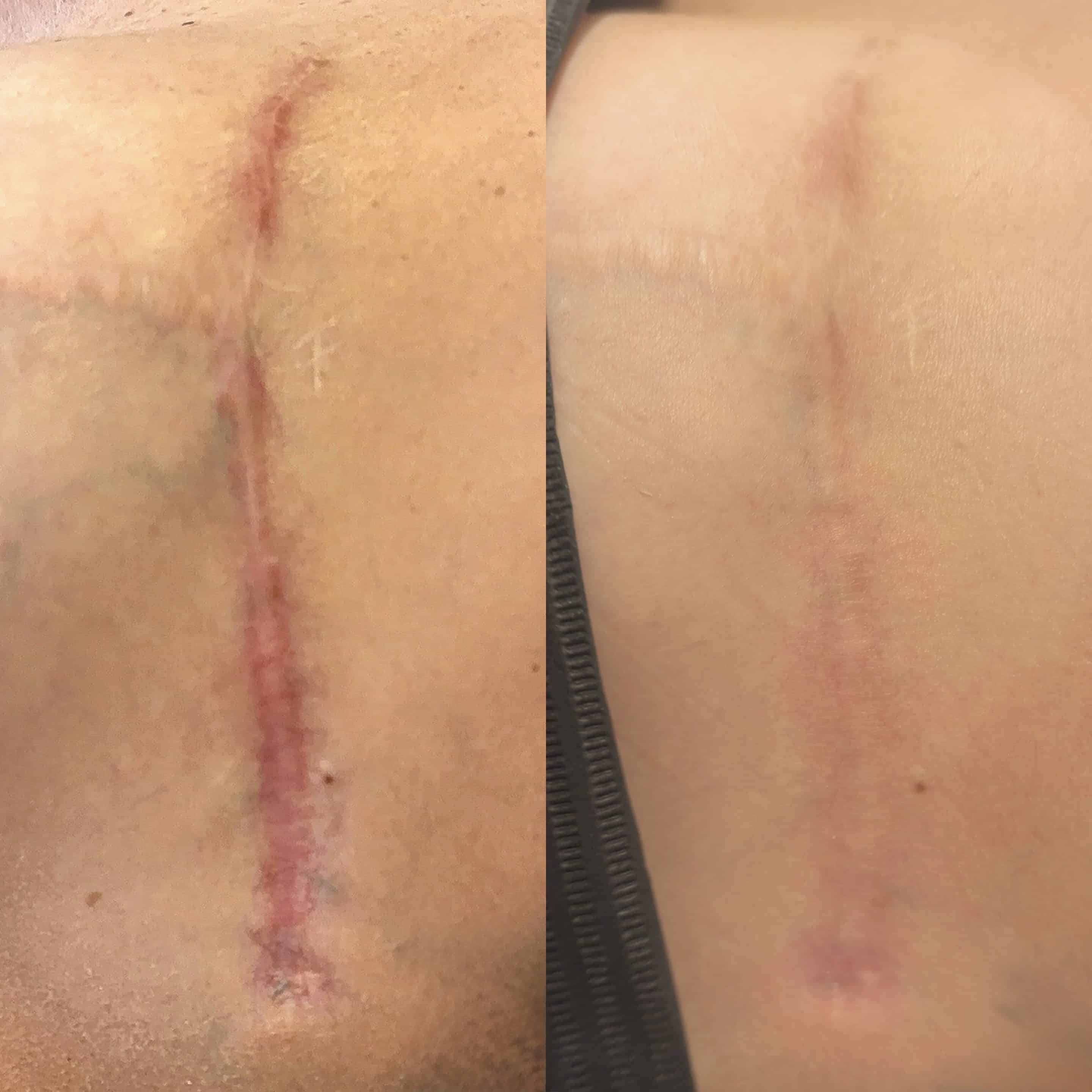 Before and after scar treatment