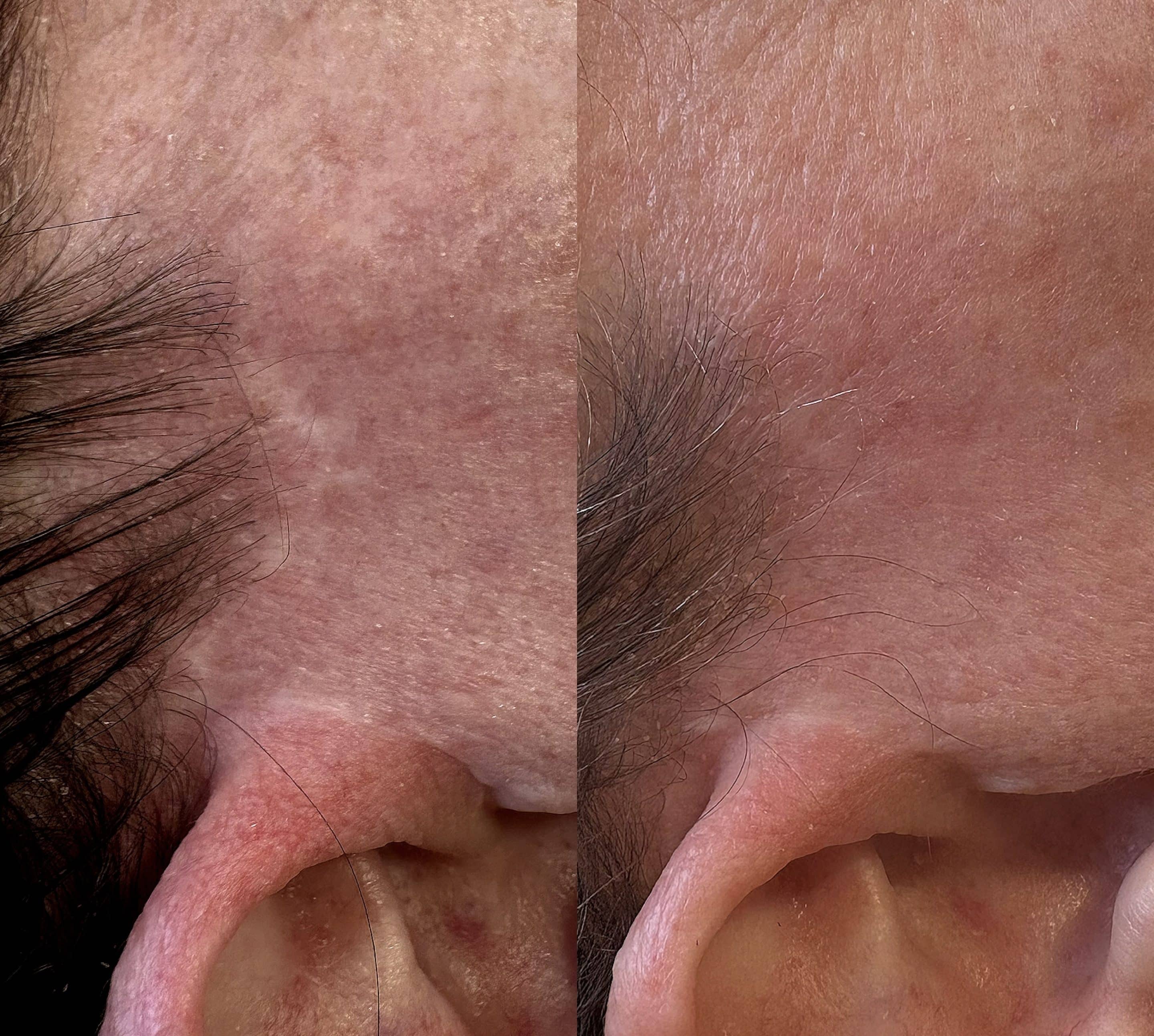 Before and after scar treatment