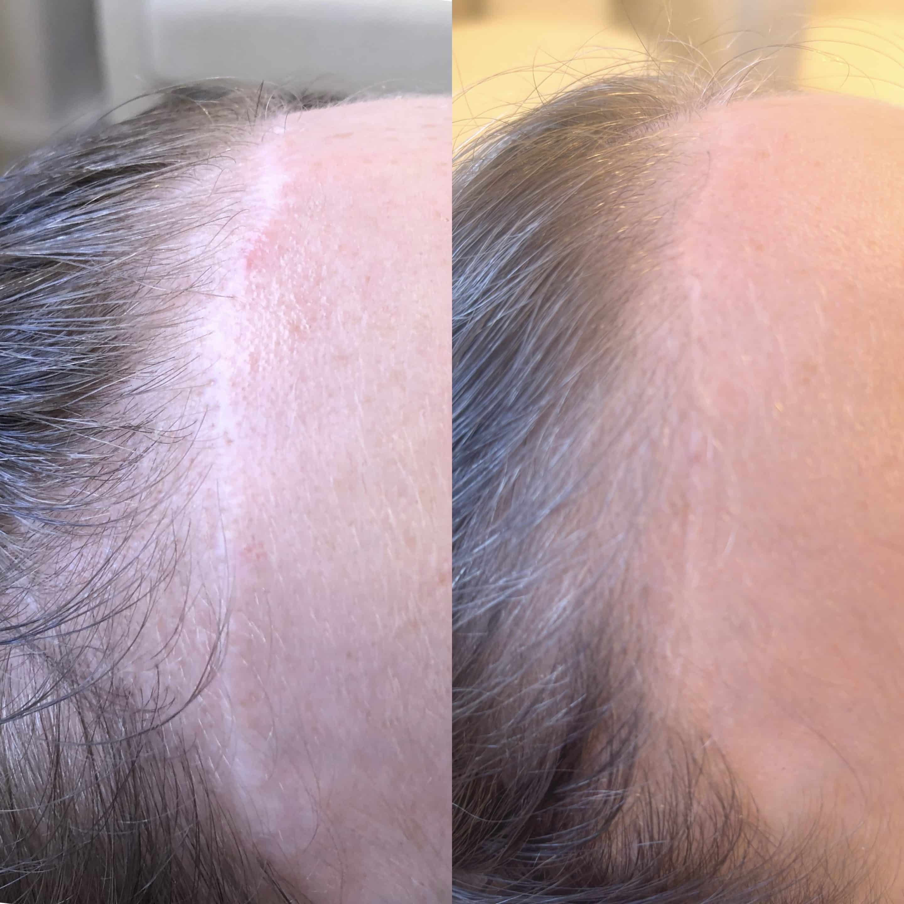 Before and after scar treatment