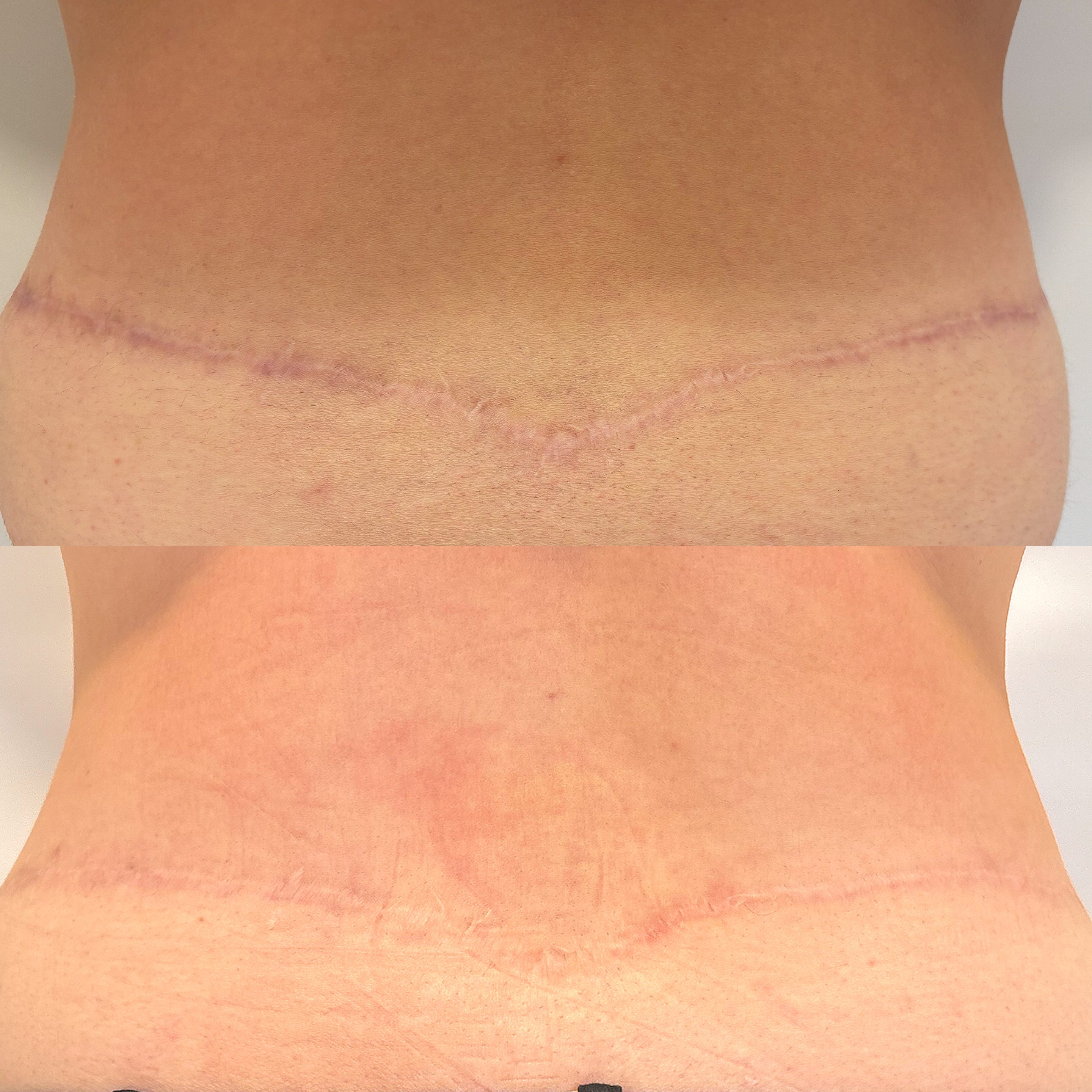 Before and after scar treatment