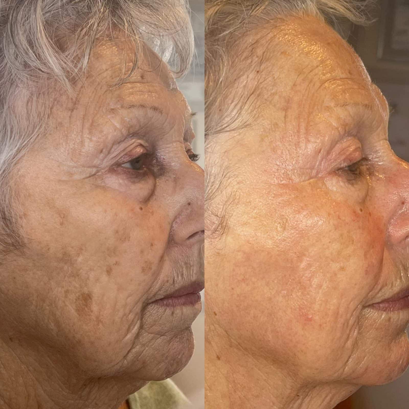 Warm Plasma before and after