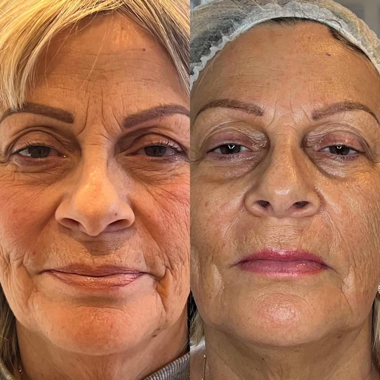 Warm Plasma before and after