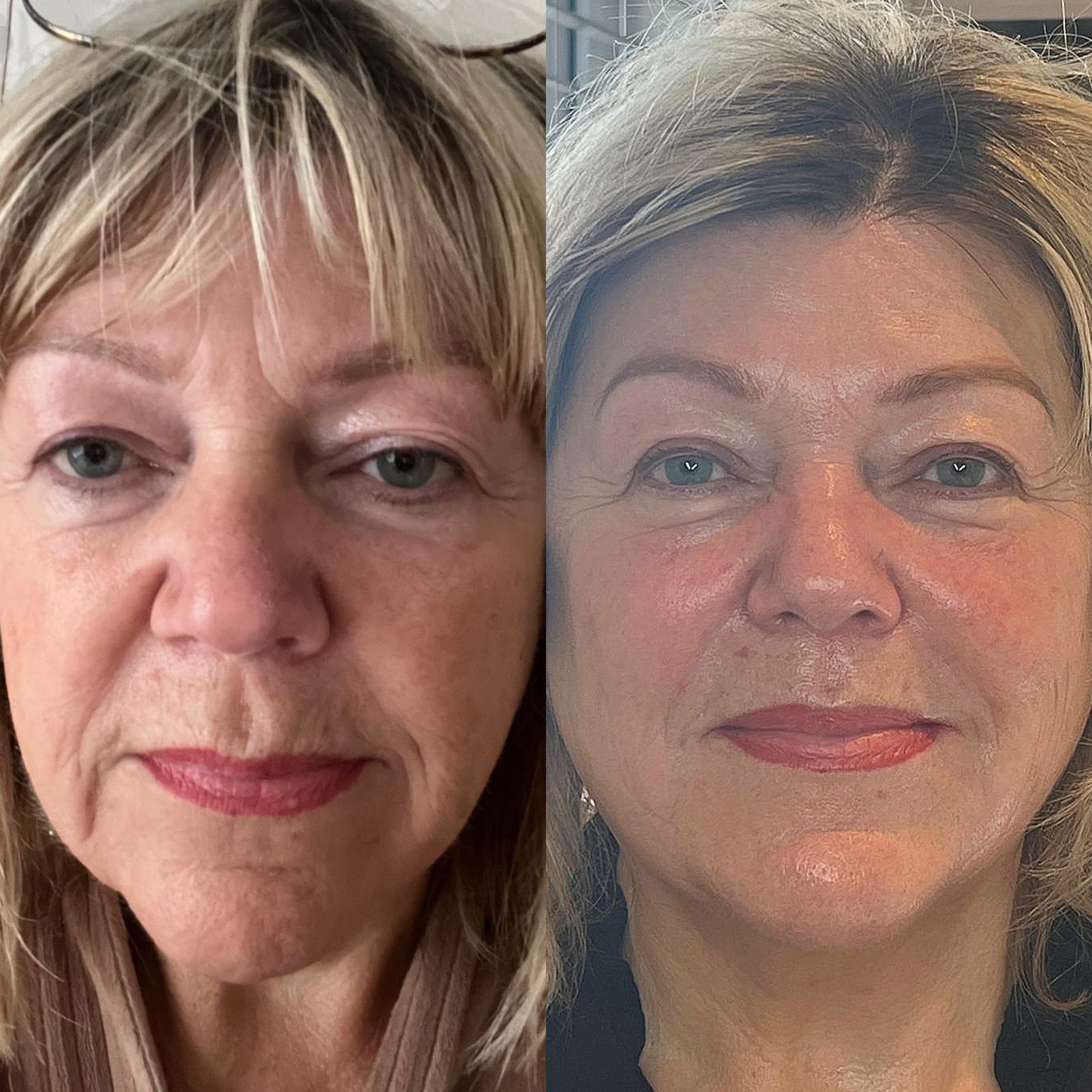 Warm Plasma before and after
